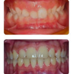 The Latest Orthodontic Treatments Available Near Beverly Hills 