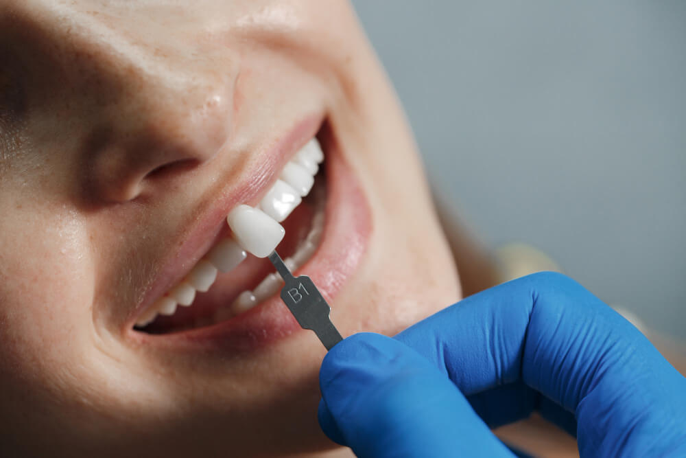 Composite Bonding